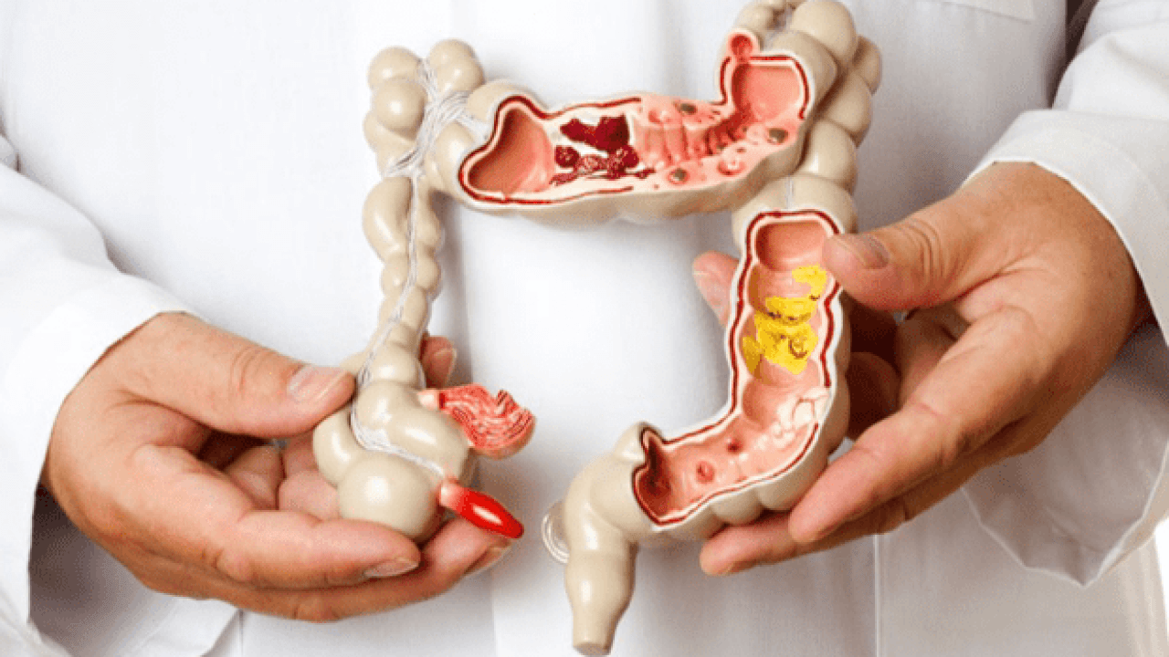 التهاب القولون التقرحي