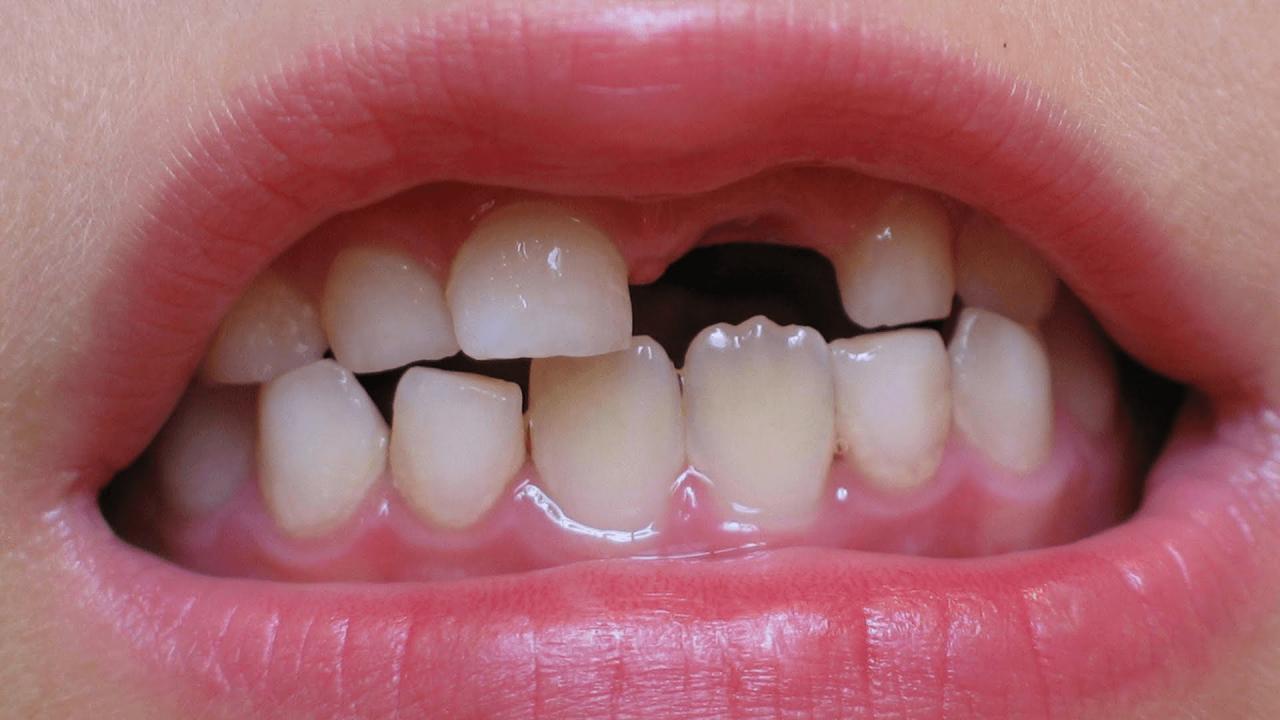 تفسير حلم وقوع الاسنان للعزباء: