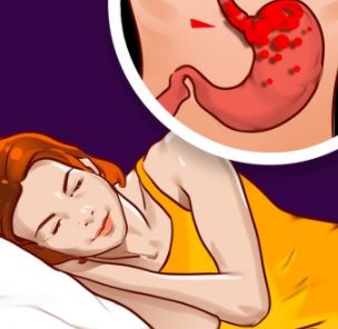 حرقان القلب