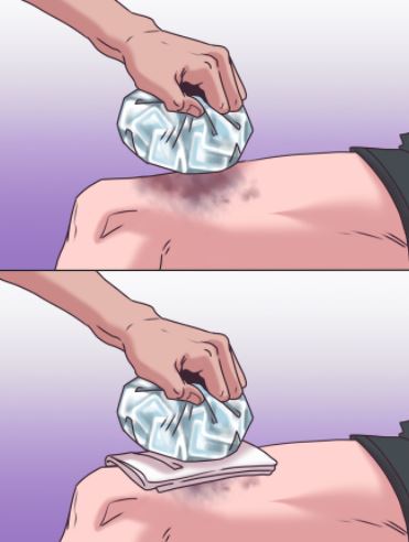 وضع الثلج مباشرة على الكدمات