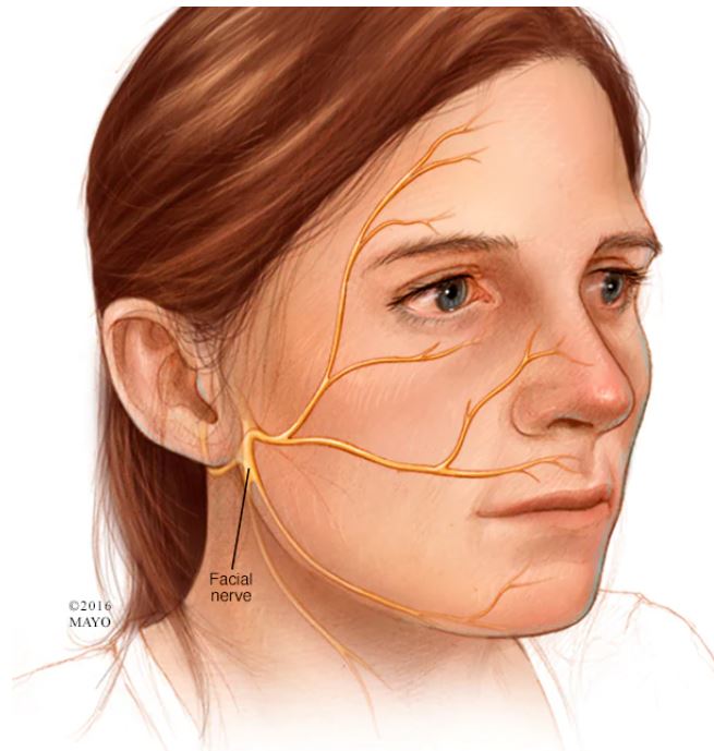 متلازمة رامزي هانت