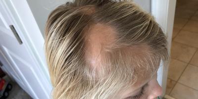 منها عصير البصل وزيت السمك.. حلول فعالة لوقف تساقط الشعر والثعلبة