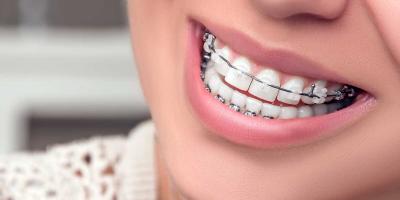 لماذا يجب تجنب تناول الفشار إذا كنت تضع تقويم الأسنان؟