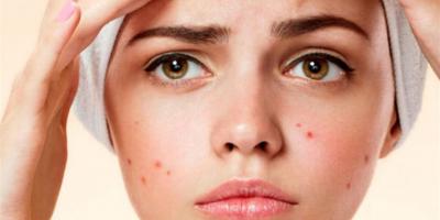 وصفات منزلية للتخلّص من حب الشباب