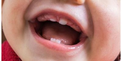 متلازمة حساسية الفم عند الأطفال.. الأعراض والأسباب ونصائح الوقاية