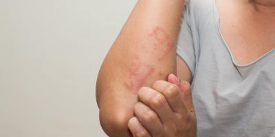 لماذا لا يمكن ترك الصدفية دون علاج؟