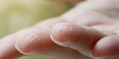 ما هي أسباب تقشر جلد الأصابع ومتى يجب رؤية الطبيب؟