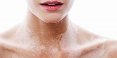 5 وصفات طبيعية لعلاج مرض البهاق