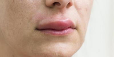 كيف يتم علاج لدغة البعوض على الشفاه؟