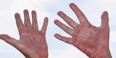 هل الاكزيما علامة على ضعف جهاز المناعة؟