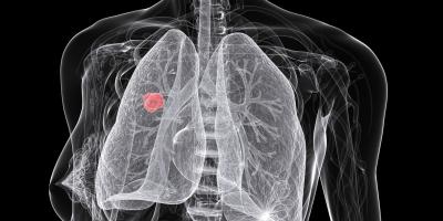6 خرافات ومعلومات زائفة عن سرطان الرئة..لا تصدقها