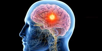 9 طرق لمنع نوبات الصرع.. تعرفي عليها