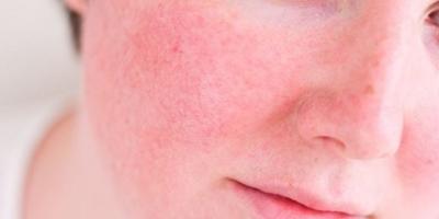 7 علاجات طبيعية فعالة لتخفيف أعراض 