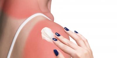 تعرفي على فوائد زيت جوز الهند لعلاج حروق الشمس