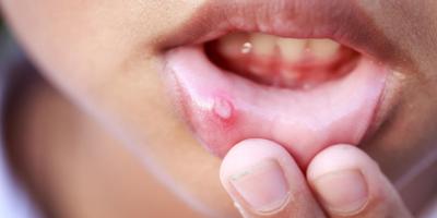 هل يؤثر داء بهجت على الإنجاب؟