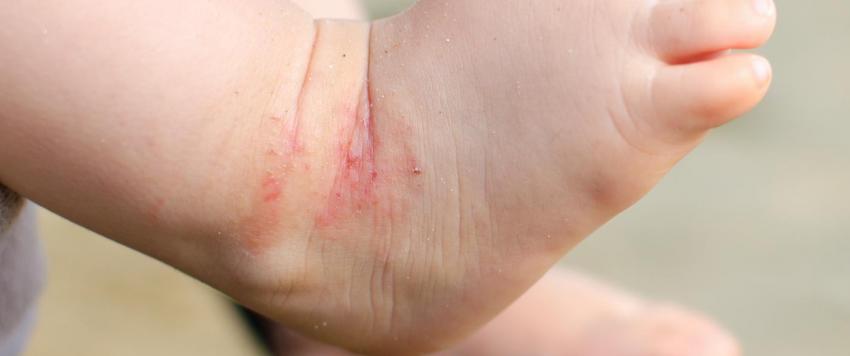 أكزيما الأطفال الرضّع