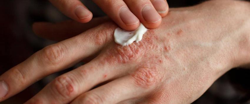 علاجات طبيعية للاكزيما