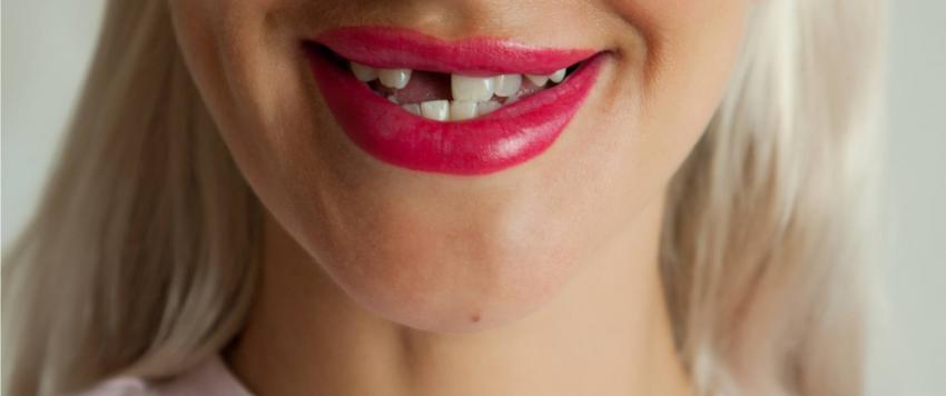 وقوع الأسنان