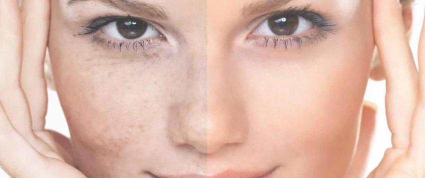 تصبغات الجلد