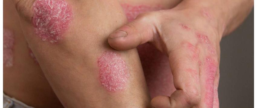 مرض الصدفية