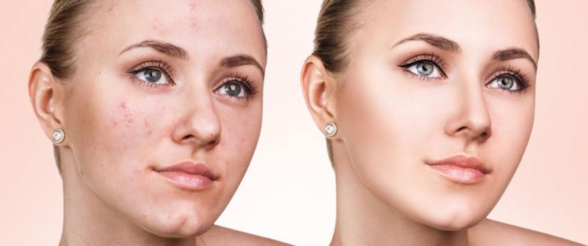 علاج حب الشباب