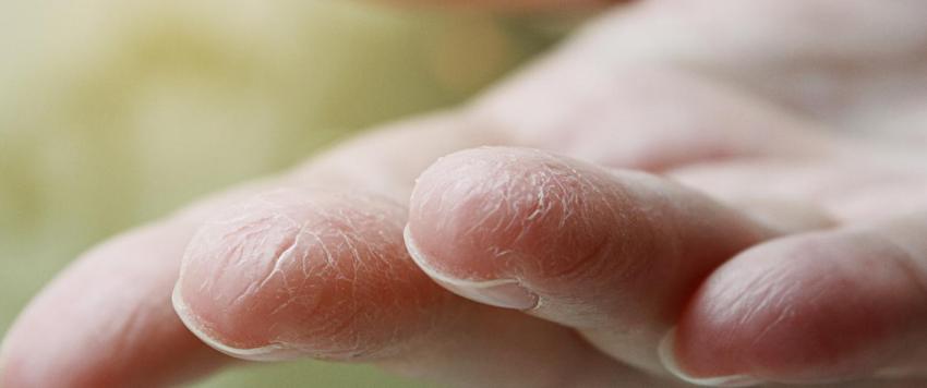 ما هي أسباب تقشر جلد الأصابع ومتى يجب رؤية الطبيب؟