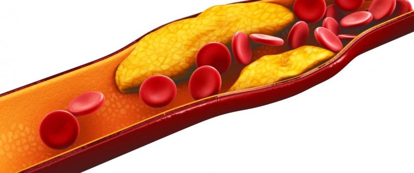 نصائح لخفض الكوليسترول في الدم وعلاجات طبيعية لارتفاعه