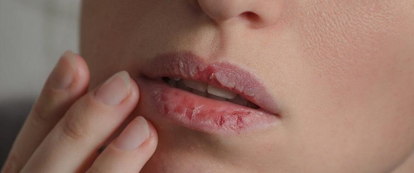 ودّعي شفاهك المتشققة.. إليكِ 3 علاجات منزلية بسيطة