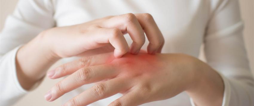 هل يمكن أن يعالج صابون حليب الماعز الأكزيما؟