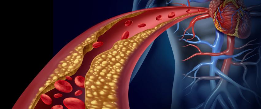  7 طرق لتقليل الدهون الثلاثية في الدم بشكل طبيعي
