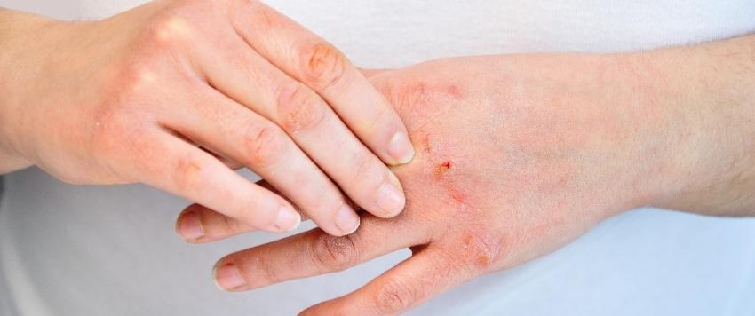 6 طرق لحفظ يديك الجافة في المنزل