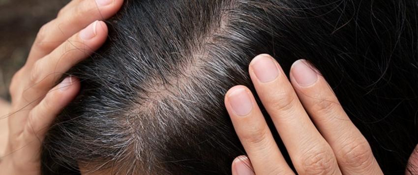 إليكِ أفضل العلاجات المنزلية لوقف شيب الشعر المبكر