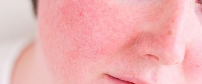 7 علاجات طبيعية فعالة لتخفيف أعراض "الوردية"