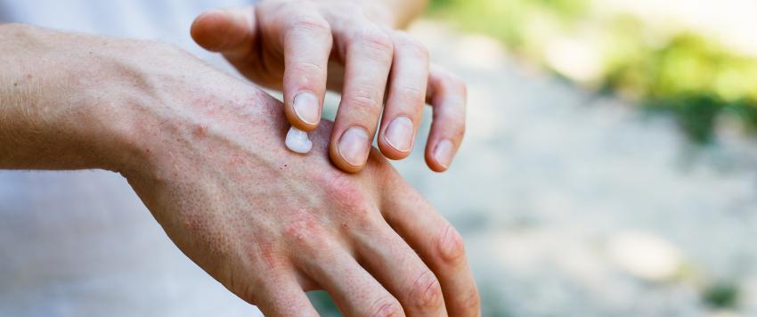 الصدفية: أسئلة مكررة، وشائعات شائعة