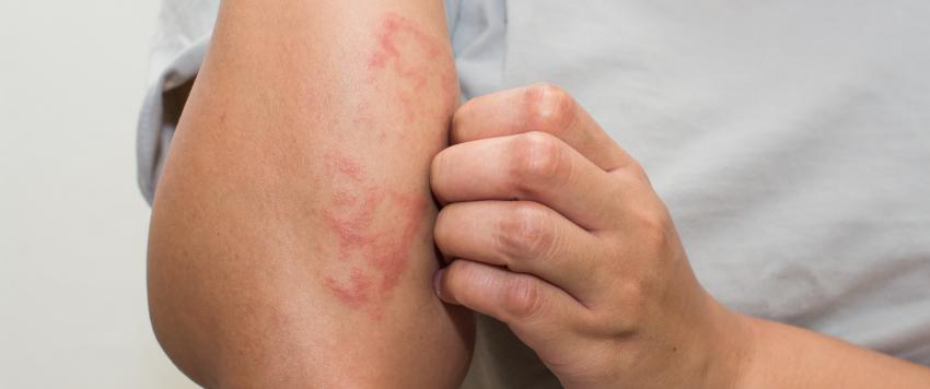 الأكزيما الدهنية: الأسباب، الأعراض، العلاج