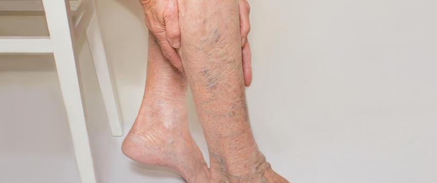 دوالي الساقين