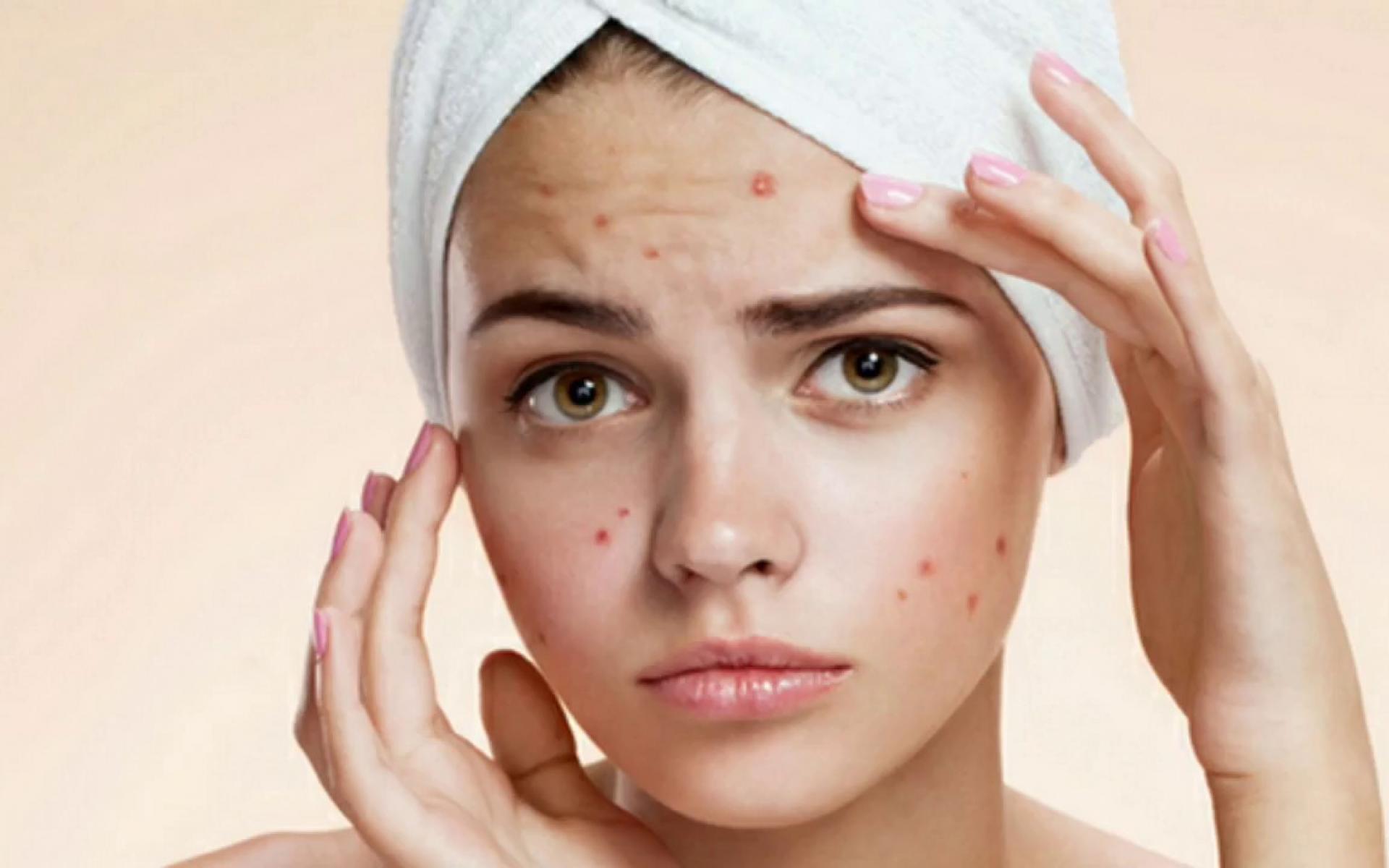 2- التخلص من حب الشباب: تمتلك الفراولة مواد غذائية حمضية، تساعد على التحكم بزيوت البشرة المفرطة، الناتجة عن ظهور حب الشباب والبثور.